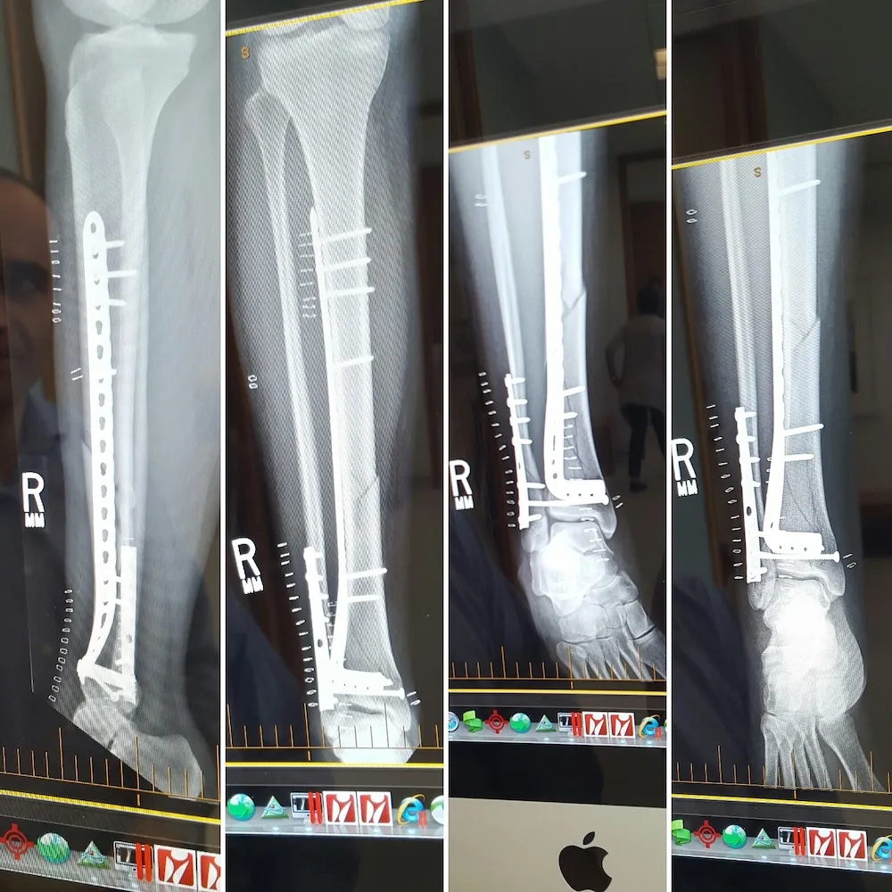 Four photos of a computer screen showing x-rays of a leg with a plate on the tibia and fibula